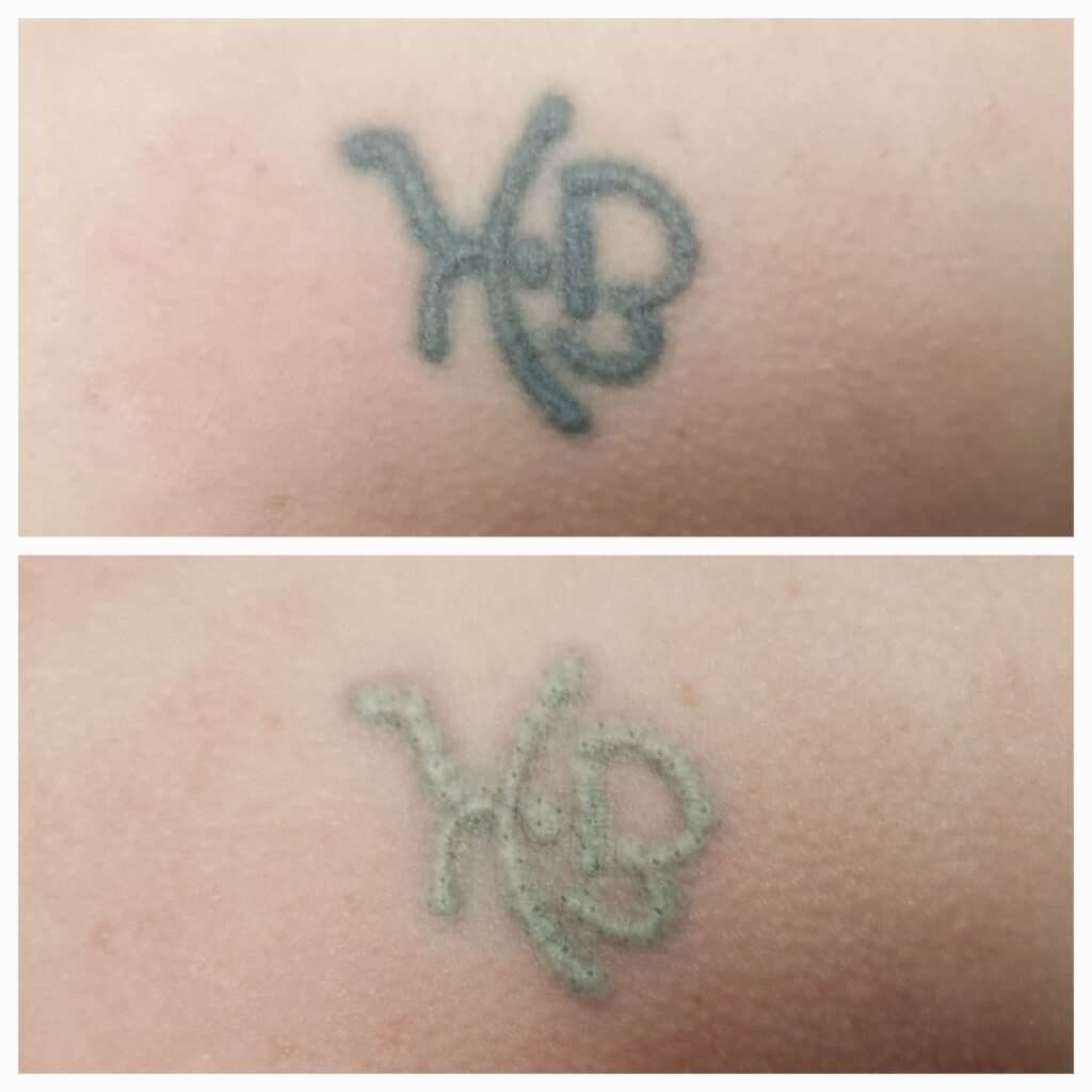 Før og efter fjernelse af tatovering